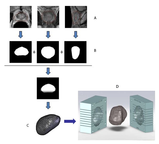 Process of MR imaging to patient-specific prostate mold/slicer