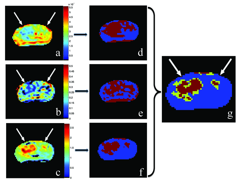 Positive-if-all-Positive approach for combining three unique DW-MRI parameters