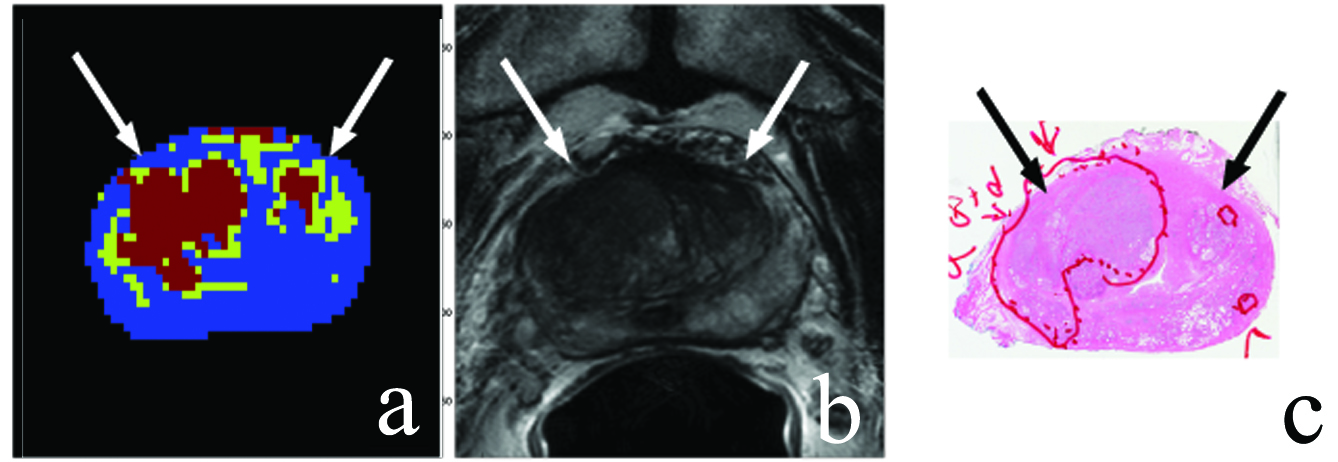 Unsupervised framework map, weighted MR image, and histology slide