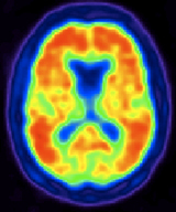 Una tomografía TEP de un cerebro