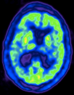 Una tomografía TEP de un cerebro