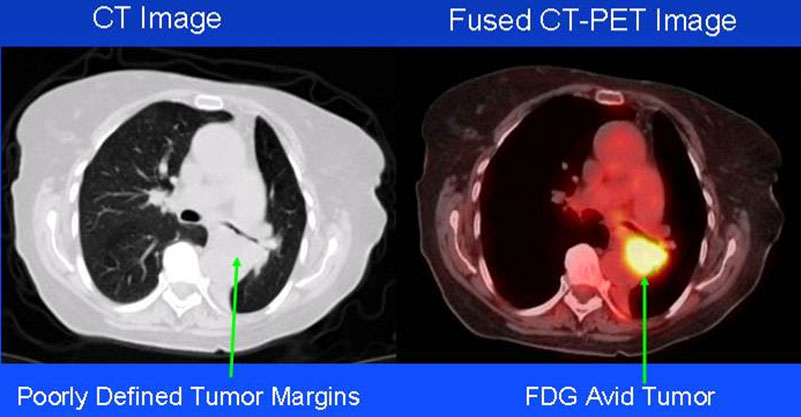 An image of a CT scan on a left and a fused CT-PET scan on the right. A tumor is clearly visible in the scan on the right and cannot be seen clearly in the CT scan.