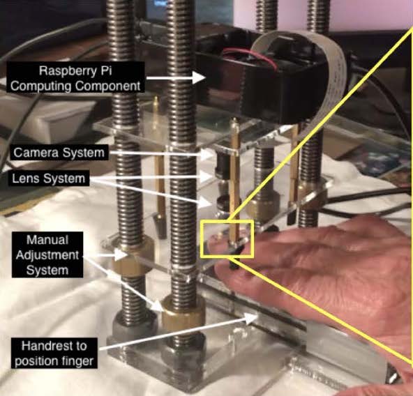 Image of the Onchoscope with a hand under the lens.