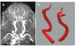 A CT photo of arteries and a red 3D rendering of arteries