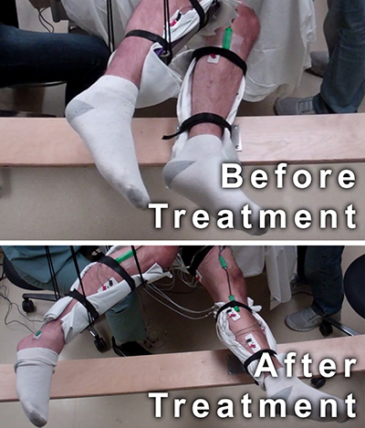 These two photos of the subject's legs suspended in braces show the change in the range of movement from before treatment and after treatment. In the before treatment photo, the subjects legs are positioned close together. In the after treatment photo, the feet are about four feet wide.