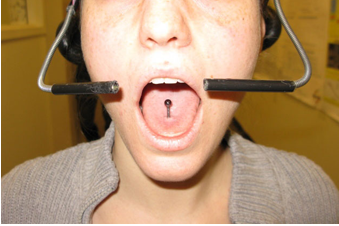 Foto de una boca abierta con la perforación de lengua que controla el sistema Tongue Drive para silla de ruedas