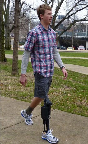 Foto de un hombre joven caminando con una prótesis de pierna robótica