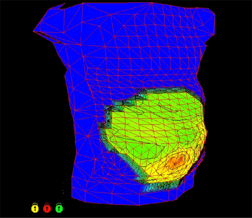 A heat map of a pregnant person’s abdomen, showing uterine muscle activity in hotter colors