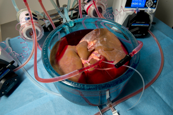 A liver in a large blue vat submerged in liquid and hooked up to the machine profusion system