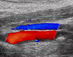 Esta es una foto de un ultrasonido Doppler a color mostrando restauración del flujo sanguíneo después de una histotripsy 