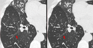 computed tomography scan of the chest using conventional CT detector and photon-counting detector 