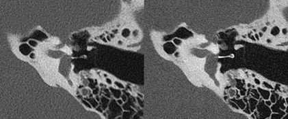 computed tomography scan of the inner ear using conventional CT detector and photon-counting detector 