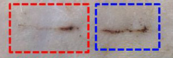 Comparison of wound healing with and without nanogenerator