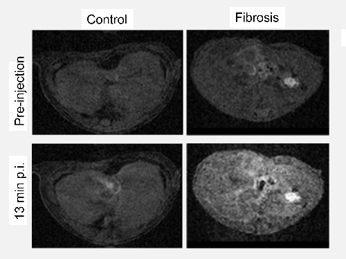 Four black and white CT images of liver fibrosis