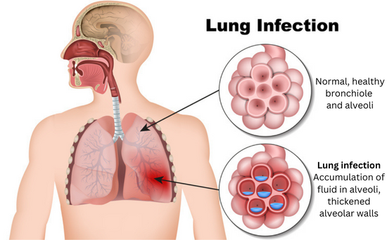 Medical drawing of the human lung, indicating how the alveoli are affected by lung inflammation