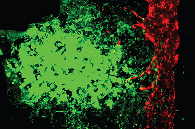 fluorscent image showing cancer cells moving invading a blood vessel