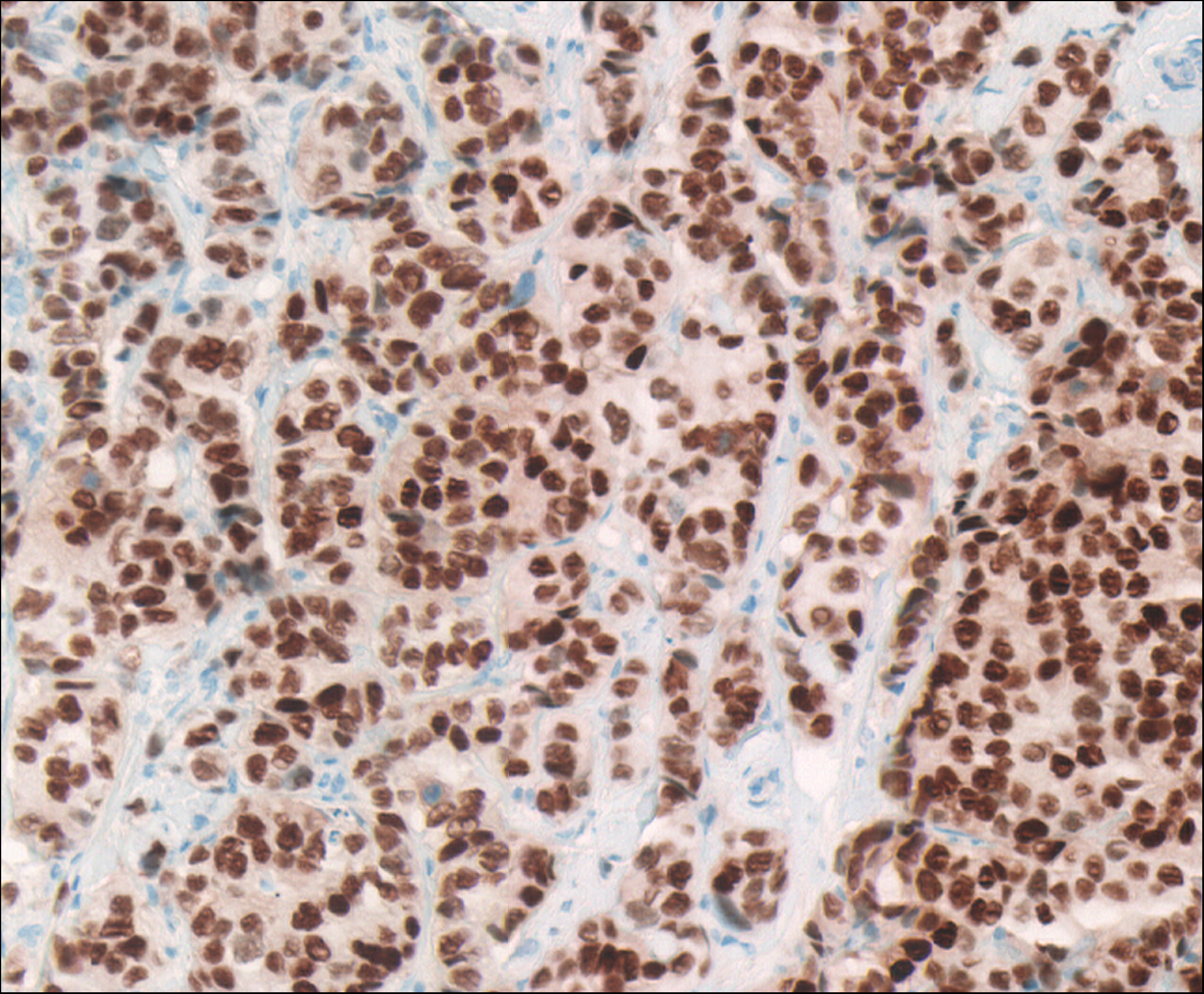 Espécimen de patología quirúrgica de cáncer de seno positivo para el receptor de estrógeno (ER) visto como portaobjetos virtual de DMetrix. La mayoría de los núcleos de células cancerosas se tiñen positivamente (marrón oscuro) para ER. Los datos de estudios de ER ayudan a predecir resultados clínicos y se usan para adaptar la terapia a cada paciente. Este espécimen se tiñó para ver ER con inmunohistoquímica. Cortesía de Ronald S. Weinstein, M.D., Universidad de Arizona.