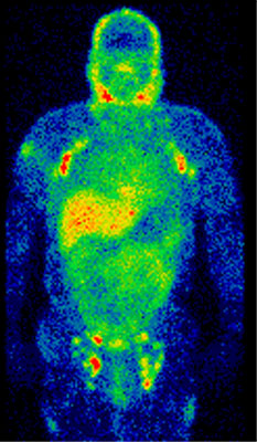 SPECT scan of a human body