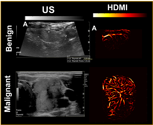 Four ultrasound images depict a thyroid tumor. Conventional ultrasound produced the images on the left, which do not capture the details of the tumor's microvasculature. The images on the right, produced by high-definition microvasculature imaging, show the vessels in higher detail.