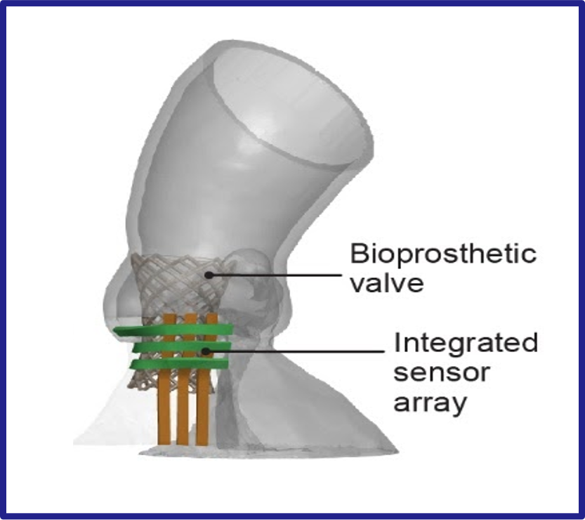 Modelo de aorta con válvula de sustitución insertada cerca de sensores integrados
