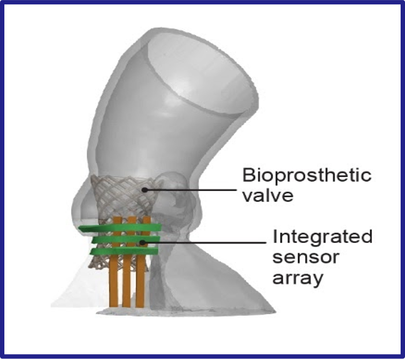 Model of aorta with replacement valve inserted near integrated sensors