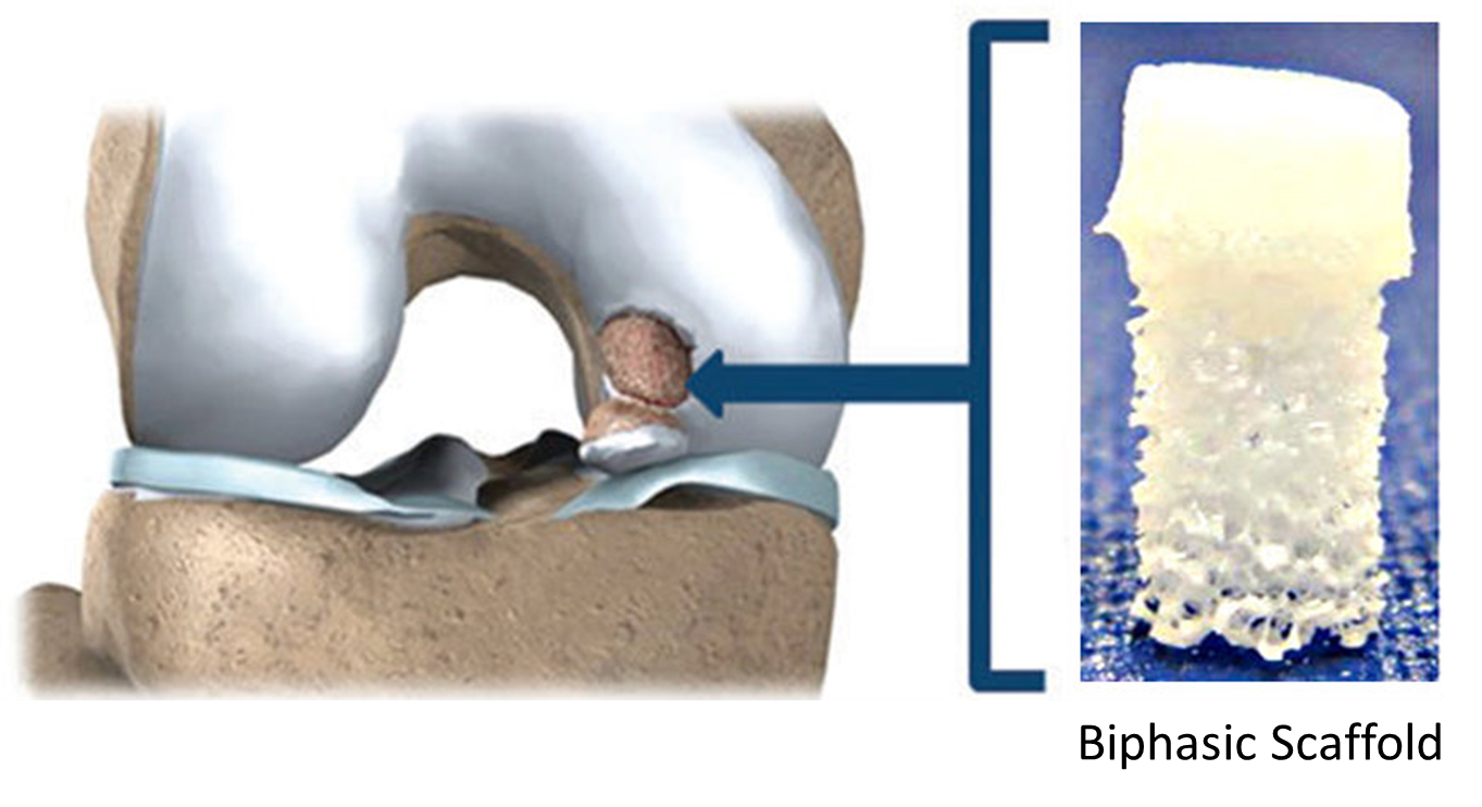 diagram of injured joint cartilage with picture of scaffold used to repair joint defect