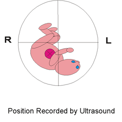 Los investigadores grabaron un feto a las 36 semanas que respondía a estímulos sonoros y monitorizaron la actividad cerebral espontánea. (Izquierda): Una viñeta indica la posición fetal intrauterina en el momento del estudio obtenida mediante ultrasonido. La localización de la actividad espontánea del cerebral (imagen superior izquierda) y la respuesta a estímulos sonoros (imagen inferior izquierda) se muestra con 151 sensores del sistema SARA. Un mapa codificado por colores muestra la distribución de los campos magnéticos de actividad cerebral y respuesta a sonidos. (imagen superior e inferior derechas). El código de colores se basa en la intensidad y la dirección de los campos magnéticos en un punto de tiempo determinado. Imagen cortesía de Hari Eswaran.