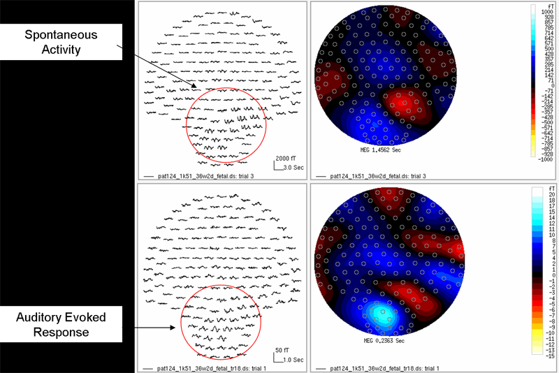 Map showing magnetic field distribution for brain activity and sound response