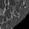 Comparison of 3D images using a standard breast coil (top) and the custom Stanford breast coil with similar scan times (bottom) in a healthy volunteer. The 18-channel array of small coils allows much sharper images to be obtained and offers clearer views of the breast in three perpendicular directions. Comparison of 3D images using a standard breast coil (top) and the custom Stanford breast coil with similar scan times (bottom) in a healthy volunteer. The 18-channel array of small coils allows much sharper images to be obtained and offers clearer views of the breast in three perpendicular directions.