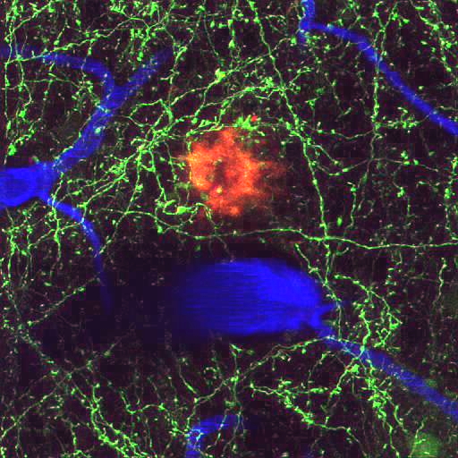 Una placa senil individual (roja) junto con neuritas que expresan proteína amarilla fluorescente (verde) del cerebro vivo de un modelo de cerebro de ratón con Alzheimer. Los vasos sanguíneos son visibles con angiografía fluorescente después de inyectarlos con “Texas red dextran” (azul). La placa mide aproximadamente 30 µm de diámetro y unos 150 µm de profundidad bajo la superficie del cerebro. Imagen adquirida por Mónica García-Alloza.