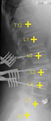 LevelCheck radiograph
