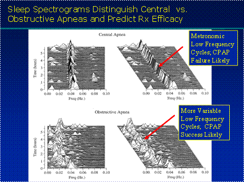 Image of sleep spectrogram Este espectrograma del sueño se produjo utilizando un novedoso programa de análisis de la calidad del sueño. La parte superior de la figura muestra dos vistas de apnea de sueño central durante una sola noche. El ritmo cardiaco cambia y la respiración se alinea en una sola fila, como una banda marcial tocando a una sola nota. Este patrón, llamado acoplamiento de "Banda estrecha", advierte que el tratamiento de presión positiva continua en el canal de aire (CPAP, en inglés) está en alto riesgo de fallar. La parte inferior de la figura muestra dos vistas de relativamente pura apnea obstructiva durante una sola noche. Los acoplamientos de corazón/pulmón tienen un patrón más variable o de “Banda amplia”. Muy probablemente la presión positiva continua del canal de aire funcionará bien.