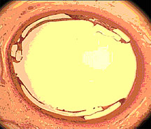 El stent biodegradable en esta arteria coronaria de un cerdo está completamente expandido y en contacto con la pared arterial. Los estudios demuestran que el stent causó poca o ninguna inflamación ni formación de coágulos. Cortesía de la imagen del Dr. Joachim Kohn, Rutgers University.
