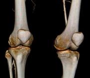 CT image of the knees