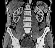 CT scan of the abdomen