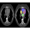 AI is applied to CT scans to automatically segment different heart chambers and identify arterial plaque