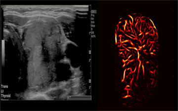 Two ultrasound images depict a thyroid tumor. Conventional ultrasound produced the image on the left, which does not capture the details of the tumor's microvasculature. The image on the right, produced by high-definition microvasculature imaging, shows the vessels in higher detail.