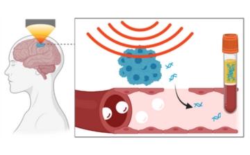 Illustration of sonobiopsy: focused ultrasound, directed at the brain tumor, helps to permeabilize the blood-brain barrier, allowing tumor DNA into the bloodstream to be collected and analyzed