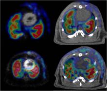 Imaging of Cardiac Infarction. Images from PET with 18F-FBEM-Cys40-exendin-4 fused with FDG PET images (left) and CT (right). Arrows point myocardial infarction site which showed high level of exendin-4 accumulation. Upper panel, control rat; lower panel, rat with myocardial infarction. This is an image of a cardiac infarction in a rat as visualized by a combined PET and CT scan. The rat with the infarction has more accumulation of the PET probe than the control rat.