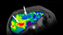 An MRE image of a liver with red, yellow, green and blue spots with two arrows, one pointing at a red area and one at a blue area.