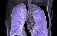 computed tomography of lungs