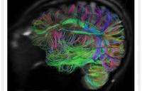 Human brain scan using MRI/DTI