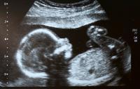 ultrasound of a baby