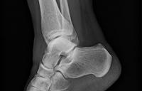 x-ray image of a human ankle