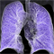 PulmonaryVolCT-TN.png Thumbnail