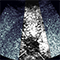 ARFI_Liver_Metastatic Carcinomathumb.png Thumbnail