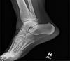 Xray image of a human ankle