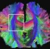 human brain scan using MRI/DTI