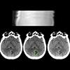 CT imaging of person's head