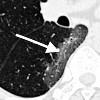 CT scan of COVID-19 lungs